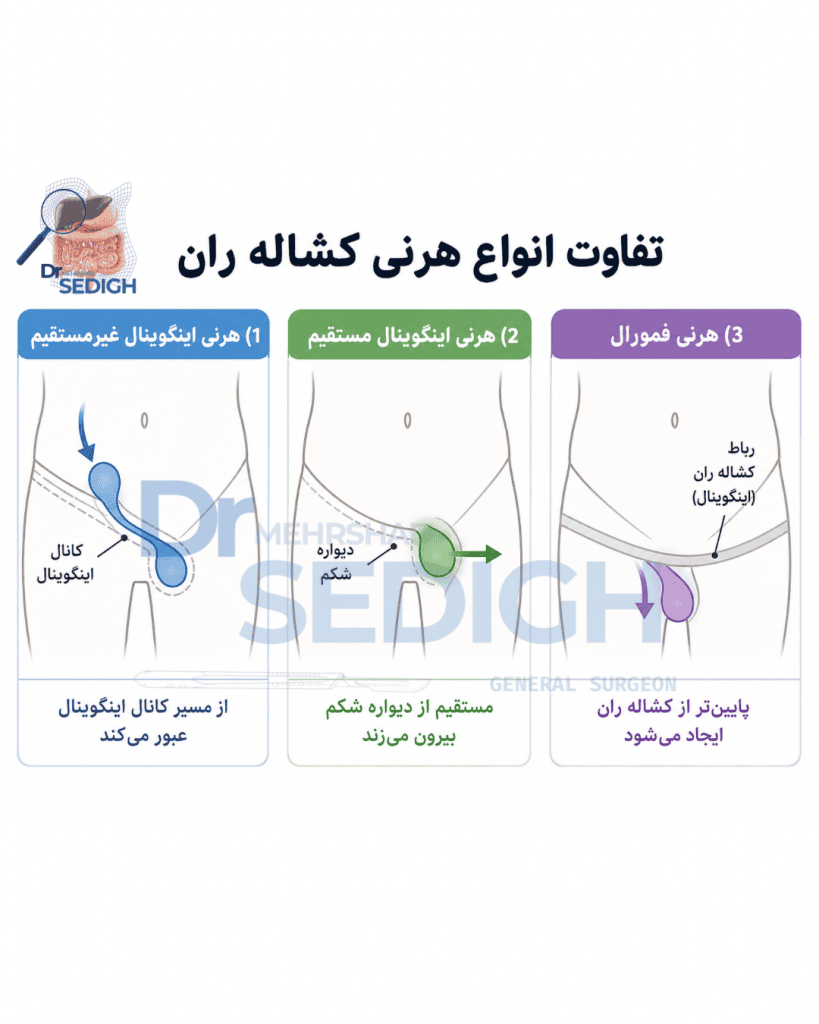 تفاوت انواع هرنی کشاله ران شامل هرنی اینگوینال مستقیم، غیرمستقیم و پانتالون