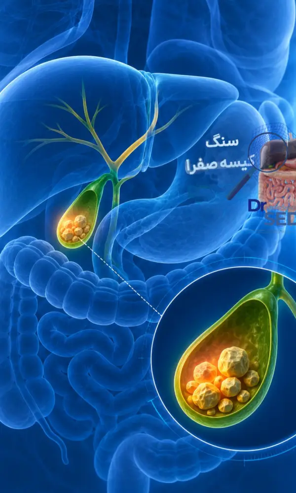 سنگ‌های کیسه صفرا در سونوگرافی و بررسی نیاز به جراحی کیسه صفرا