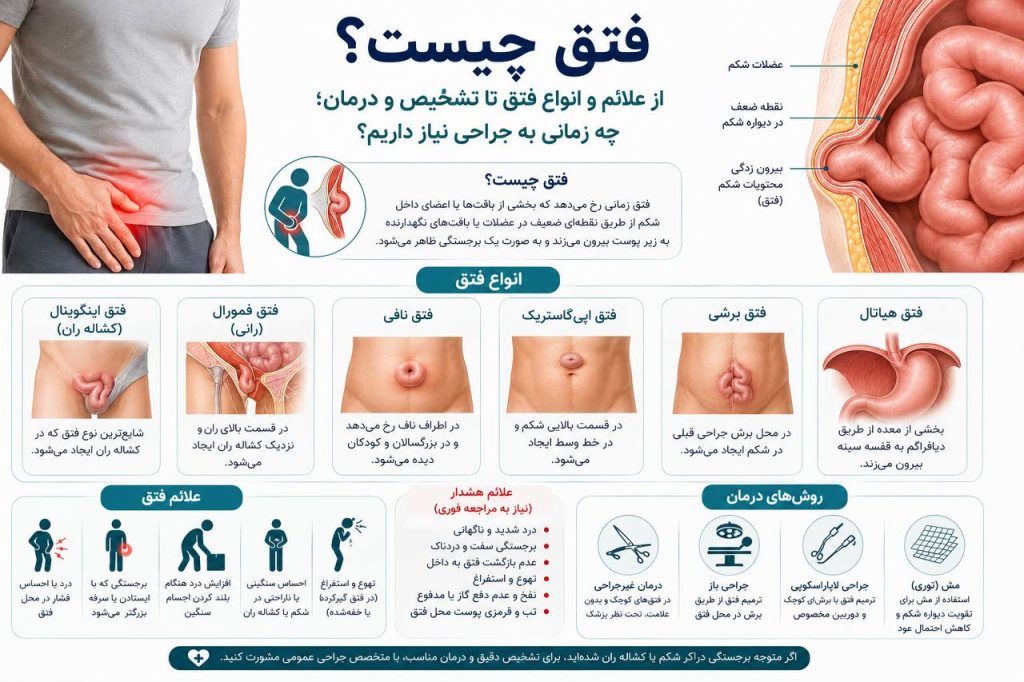 تصویر شماتیک فتق شکمی که بیرون‌زدگی بخشی از روده از طریق ضعف عضلات دیواره شکم را نشان می‌دهد.